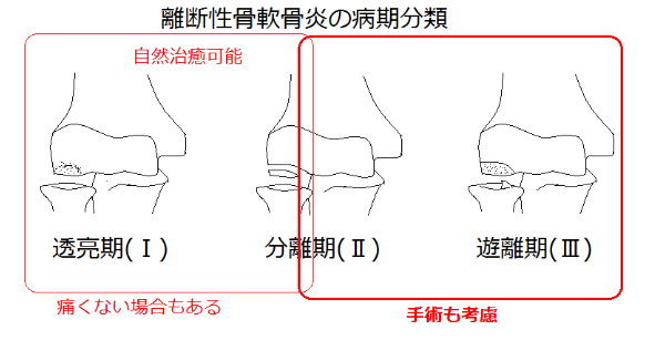 スポーツ障害「離断性骨軟骨炎」