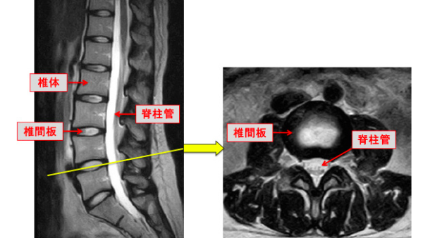 腰部脊柱管狭窄症