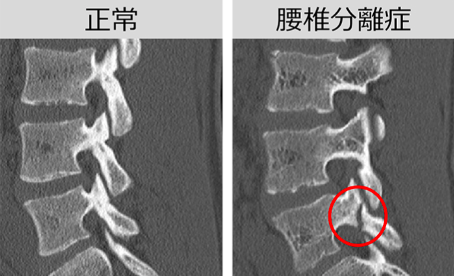 第５腰椎分離症