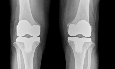 TKA（人工膝関節置換術）