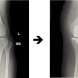 UKA（部分人工膝関節置換術）