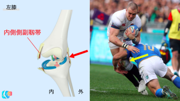 膝内側側副靱帯損傷