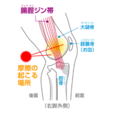 腸脛靭帯炎