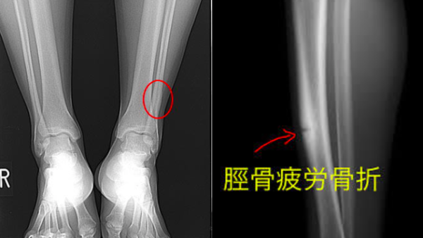 脛骨疲労骨折