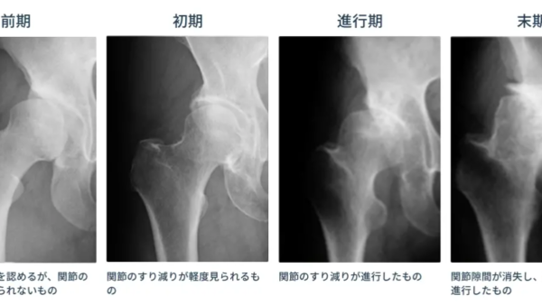 変形性股関節症