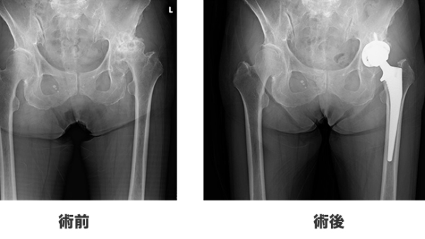 THA（人工股関節置換術）