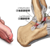 足関節外側靭帯損傷