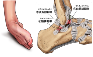 足関節外側靭帯損傷