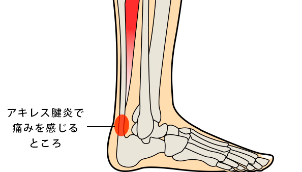 アキレス腱炎